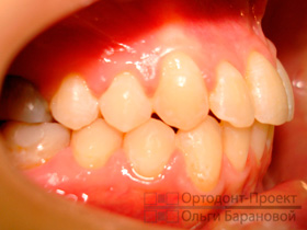 результат комплексного ортодонтического лечения - вид справа