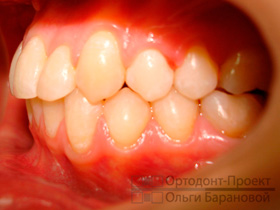 результат комплексного ортодонтического лечения - вид слева