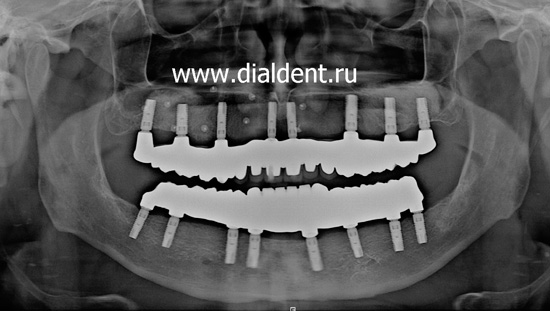 панорамный снимок зубов после протезирования на имплантах