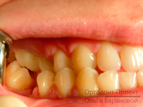 вид зубов справа до ортодонтического лечения