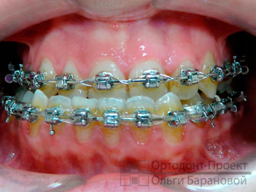 вид зубов спереди перед операцией