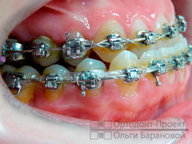 вид зубов справа перед операцией