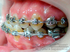 вид зубов слева перед операцией