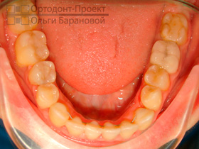нижние зубы после ортодонтического лечения