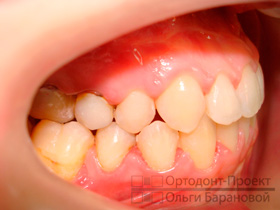 вид зубов справа после ортодонтического лечения и хирургического исправления прикуса