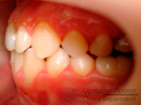 вид зубов слева после ортодонтического лечения и хирургического исправления прикуса