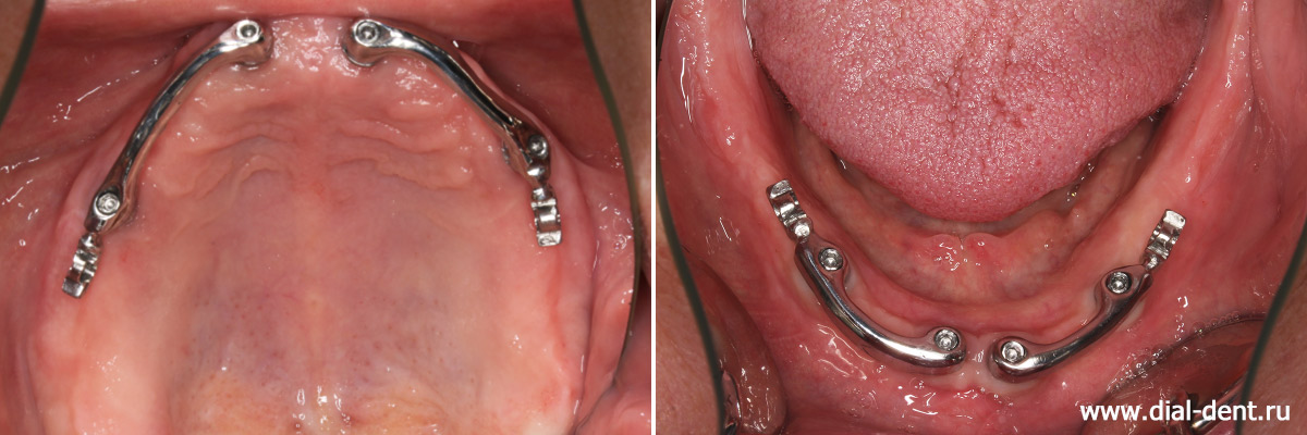 балки закреплены на зубные импланты