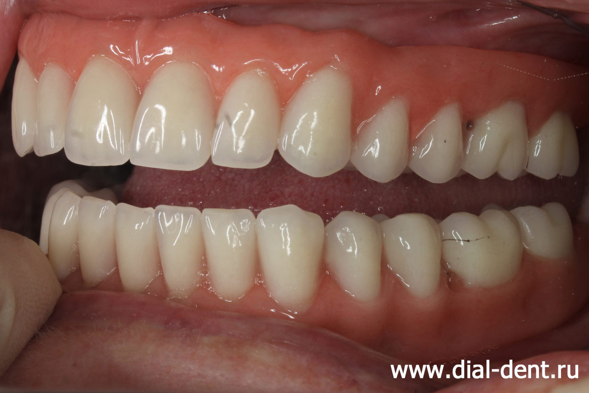 полные зубные протезы на имплантах - вид слева