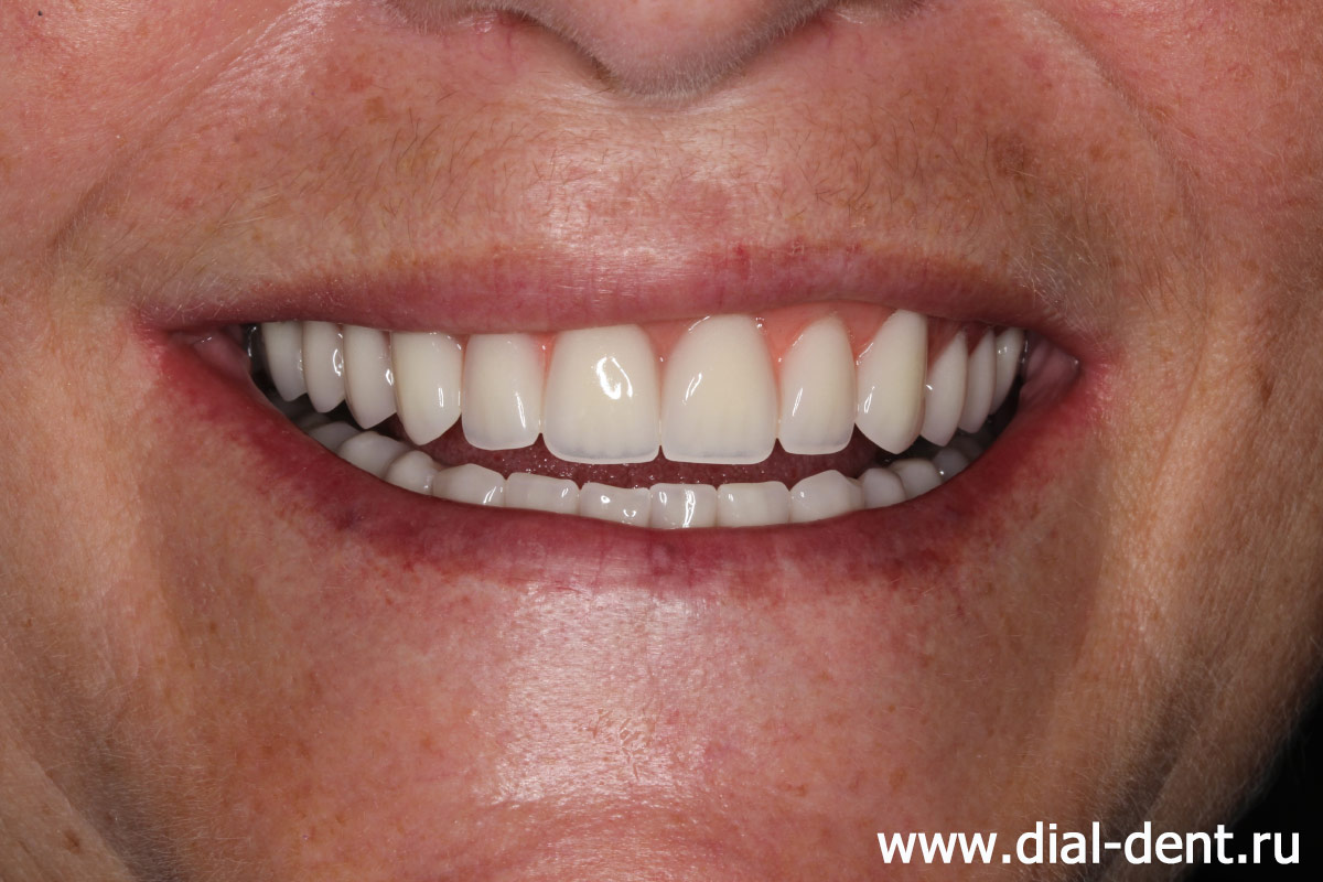 улыбка после протезирования зубов