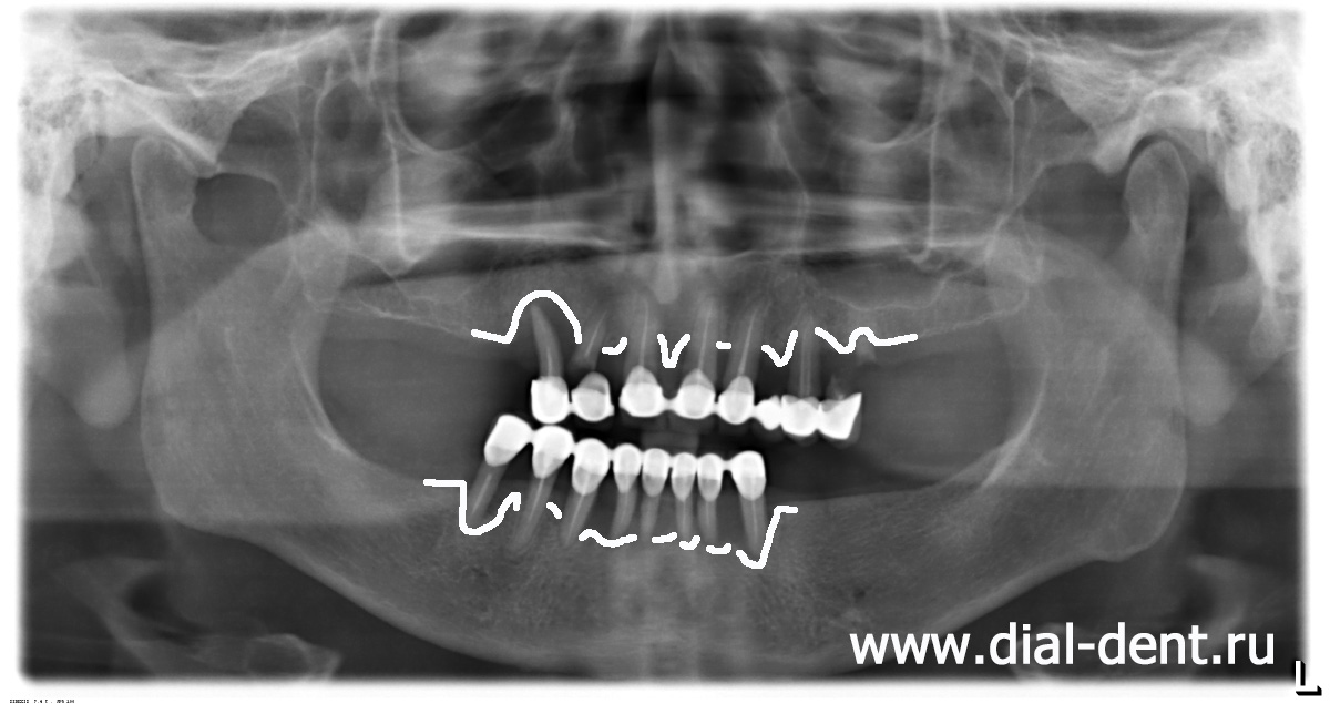 панорамный снимок зубов при обращении - показан уровень кости