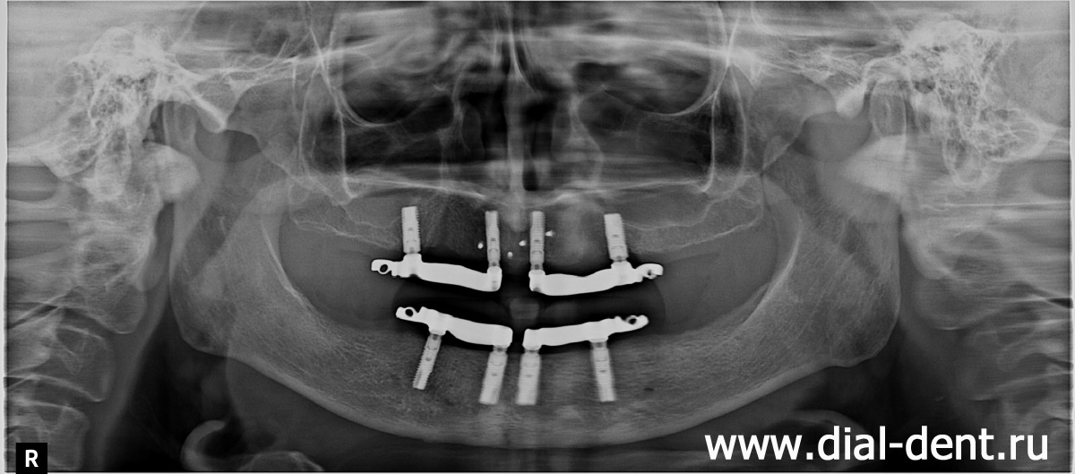 зубные импланты Astra Tech с балками для закрепления полных зубных протезов