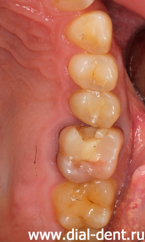 старые зубные пломбы, зуб после лечения резорциновым методом