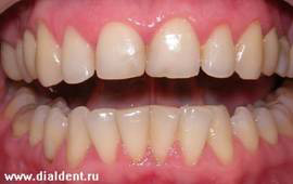 эстетические дефекты передних зубов