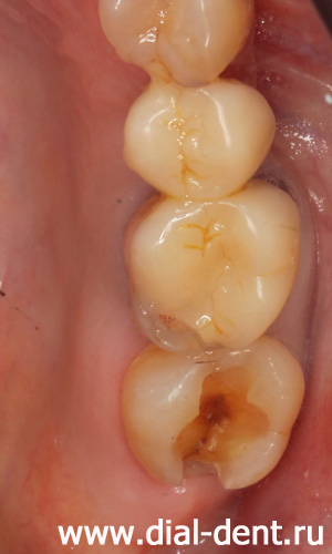 удаление старой пломбы, трещина в зубе