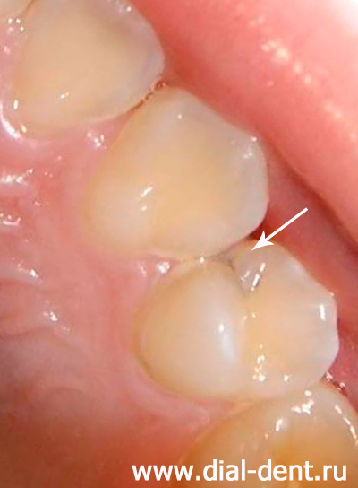 кариес зубов, скопление зубного налета