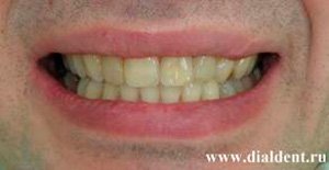 улыбка после прямой реставрации зубов