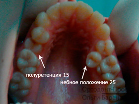 верхние зубы до начала лечения
