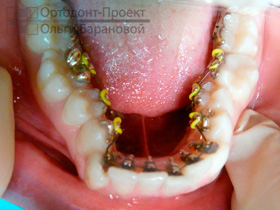 брекеты Инкогнито на нижних зубах