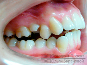 брекеты Инкогнито на зубах - вид справа
