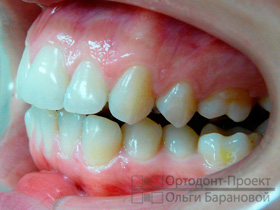 брекеты Инкогнито на зубах - вид слева