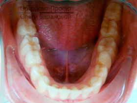 ровные нижние зубы в результате лечения