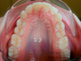 ровные верхние зубы в результате лечения