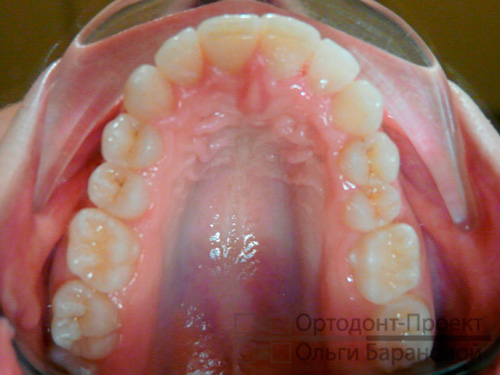 ортодонтическое лечение брекетами Инкогнито