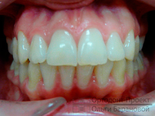 ровные зубы и здоровье ВНЧС