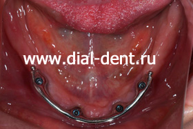 балка для закрепления зубных протезов на нижней челюсти