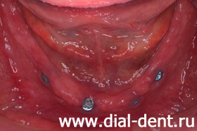 нижняя челюсть с установленными зубными имплантами