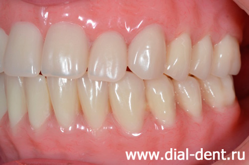 полные съемные зубные протезы с креплением на импланты - вид слева