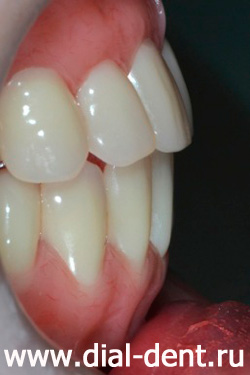 полные зубные протезы