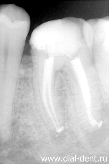 запломбированы 4 канала зуба