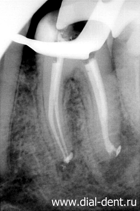 временно запломбированные каналы зуба
