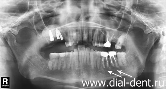 панорамный снимок зубов после лечения каналов