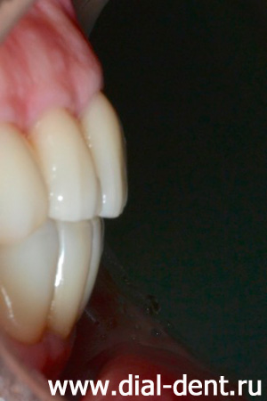 вид передних зубов сбоку после протезирования коронками керамическими в Диал-Дент