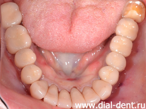 протезирование нижних зубов керамическими коронками и металлокерамикой, в том числе на имплантах
