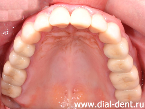 протезирование зубов верхней челюсти керамическими коронками и металлокерамикой