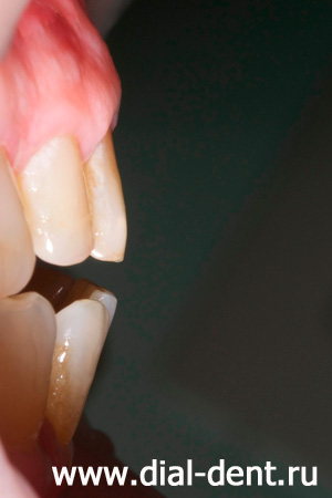 вид передних зубов сбоку до лечения 