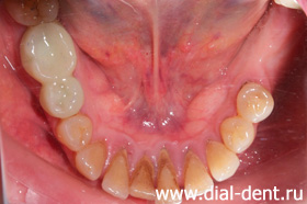 нижние зубы до лечения и протезирования