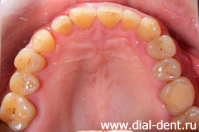 верхние зубы до лечения и протезирования