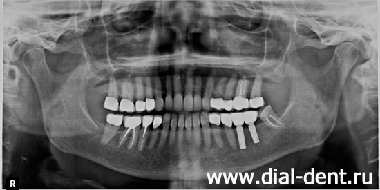 панорамный снимок зубов после имплантации, лечения каналов и протезирования зубов в Диал-Дент