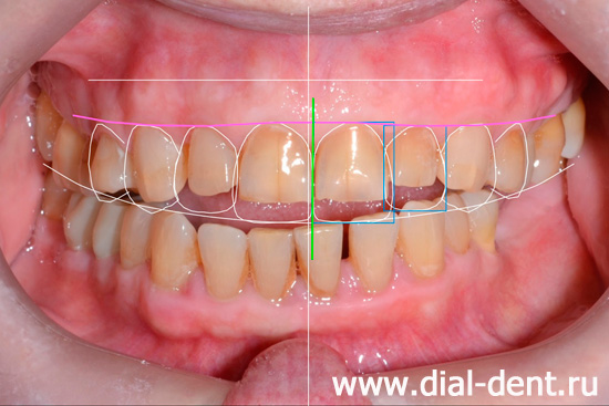 планирование протезирования зубов в Диал-Дент