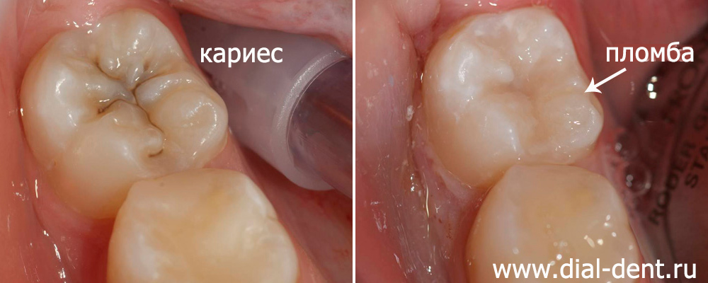 зуб до и после лечения кариеса