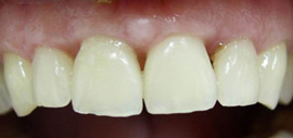 передние зубы после лечения
