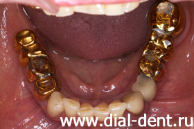 старые зубные коронки, больные зубы и десны - нижняя челюсть