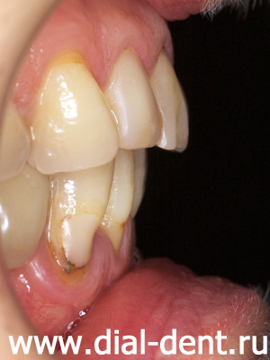 вид передних зубов до лечения и протезирования