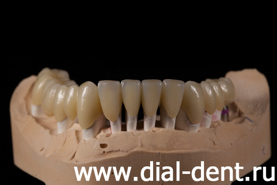 коронки керамические изготовлены в семейной стоматологии Диал-Дент