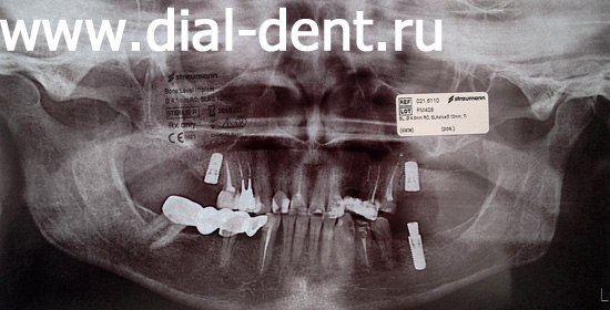 панорамный снимок зубов (ортопантомограмма) после имплантации и лечения каналов