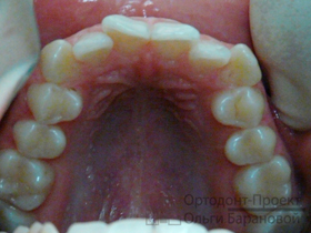 верхние зубы до лечения у ортодонта